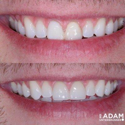 Sometimes less is more, Dr. Adam Unterbrunner drastically altered this patients appearance with only 2 veneers.