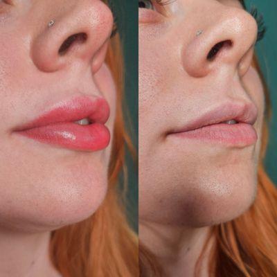 Lip blush/lip tattoo