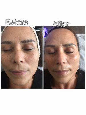 Hydroimpact skin Treatment. Turn your skin lift, glow and smooth.