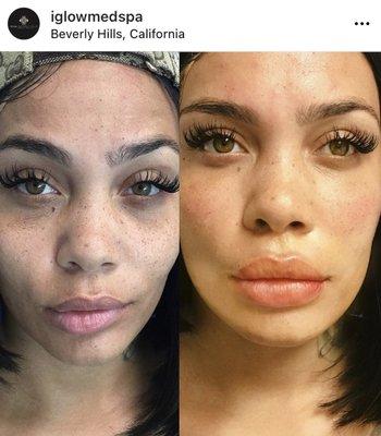 iGlowMedSpa Porter Ranch - Lip Injections Restylane Kysse & Under-eye Filler