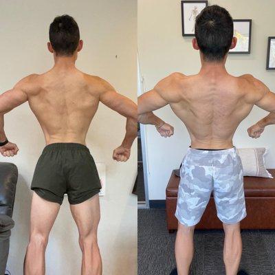 Restoring balance to my uneven lats. Just in time for my competition. Thank you Dr. Suen!