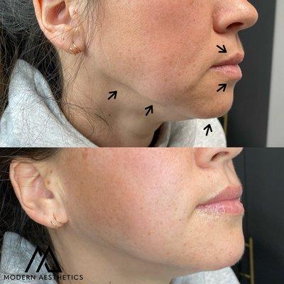 Lower Face Rejuvenation