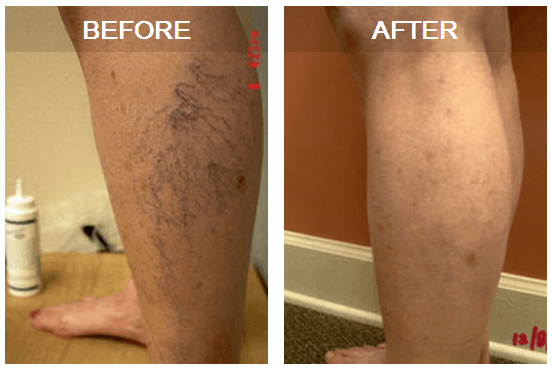 Spider Veins & Varicose Veins - minimally invasive treatment, ambulatory phlebectomy & 1 session of cosmetic sclerotherapy.