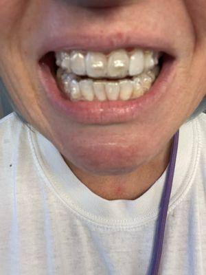 My Invisalign by Bellevue Dental Health.