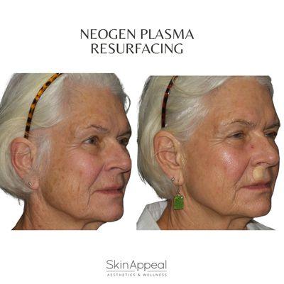 Neogen Plasma Resurfacing