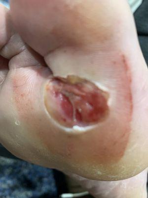 Ulcer of my right toe.