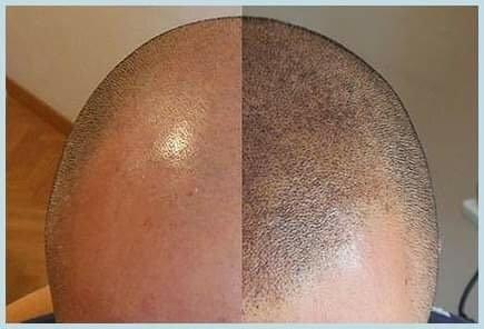 Scalp micro pigmentation