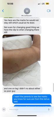 My son's bite marks he received - and the conversation between Mrs.Liz his daycare teacher