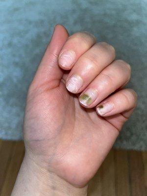 Infected nails