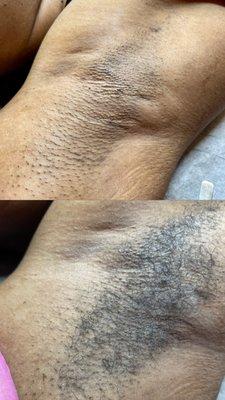 Underarm Wax