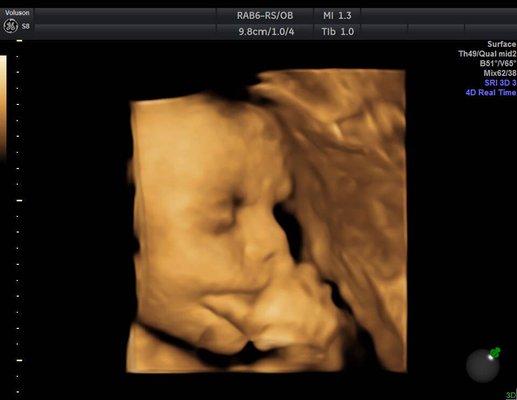 Thinking about a 4d Ultrasound ?