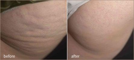 Cellulite Reduction