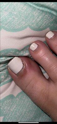 TOE INFECTION!!!!