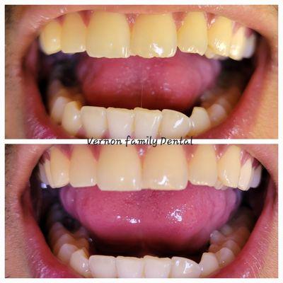 Refreshing  smile on 3 teeth. Done in 1 min with no restoration.