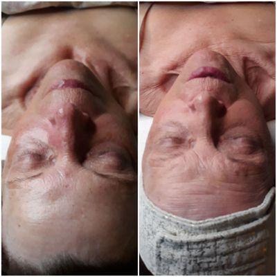 This was a recent before and after. Lots of hydration and massage got us these results.