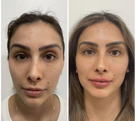 Facial balancing and transformation with EZ Gel