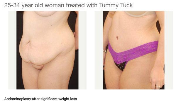 Tummy Tuck :)