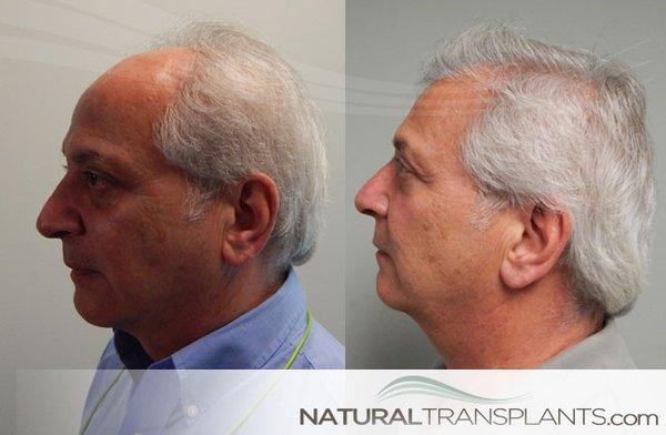 FUT Hair Transplant Jacksonville