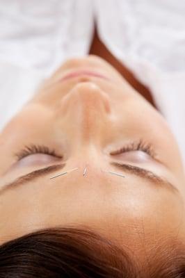 Acupuncture Face-lift