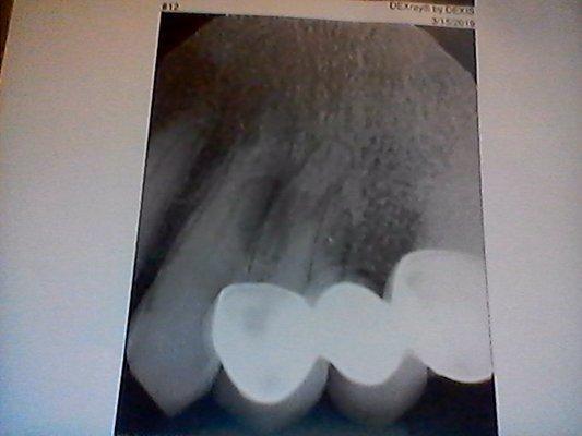 cervical resorption on teeth 11&12