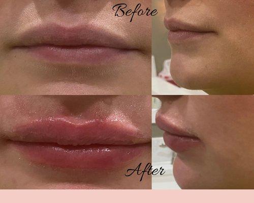 Lips injected with HA filler Restylane Kysse