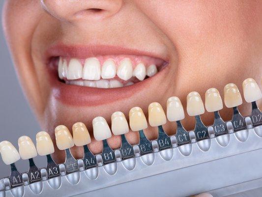 Teeth whitening is a simple process. Whitening products contain one of two tooth bleaches (hydrogen peroxide or carbamide peroxide).