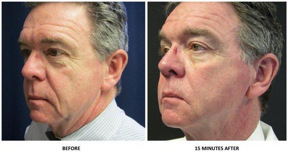 Dr. Moore before and after liquid facelift.