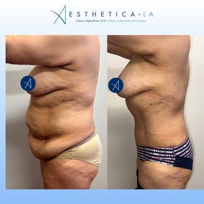 tummy tuck