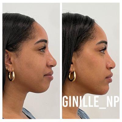 Cheeks and chin filler