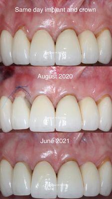 Same day/immediate implant and crown