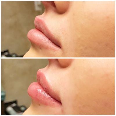 Filler lips before and after