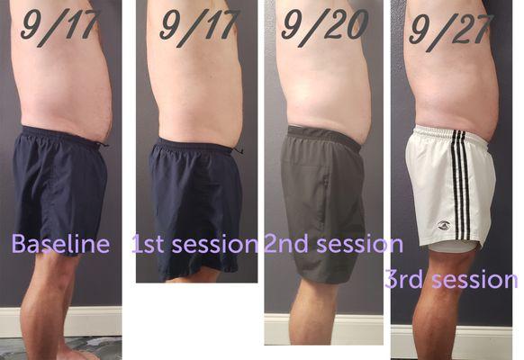 Cavitation (fat reduction) - male client 3 sessions