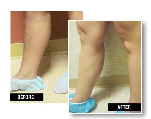 Before and After Vein Treatment