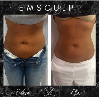 Emsculpt before and after