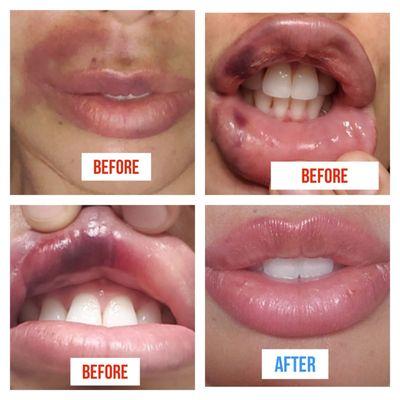 NICOLE helped reverse the effects of my own errors. Thanks to her I have my lips