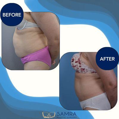 Liposuction can help eliminate stubborn fat that diet & exercise can't seem to touch.