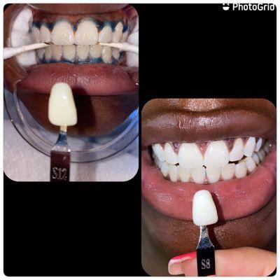 90 minute teeth whitening session