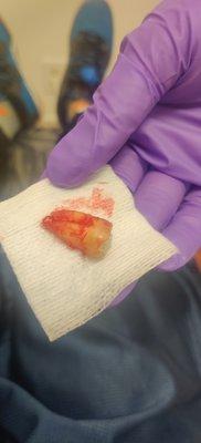 Extracted tooth