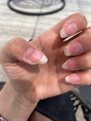 Damaged nails from years of acrylics