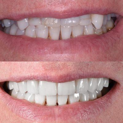 Upper and Lower Porcelai Veneers with Dental Implants