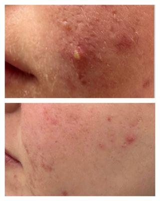 Acne treatments are amazing! After just 1 RF microneedling treatment!