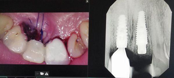 Dental implant after extraction of a resorbed abscessed tooth damaged by a skateboarding accident 10+ years ago.