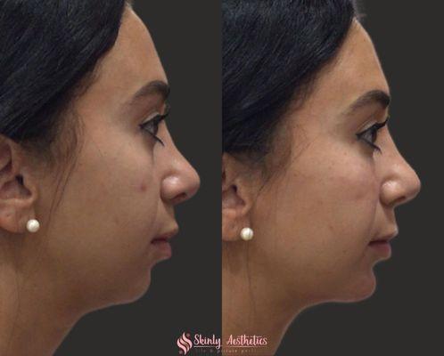 Before and after results following non-surgical chin augmentation with Juvederm filler