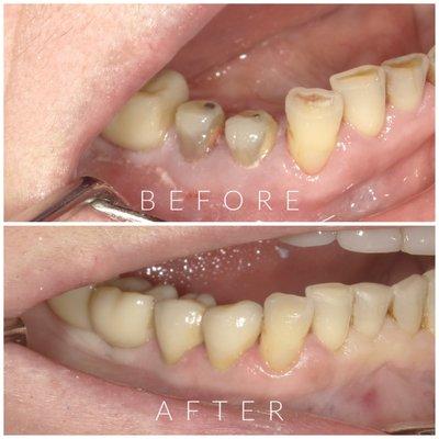 Dental Crowns Restoration