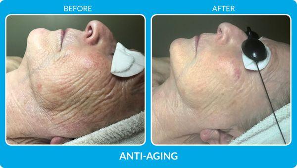 Procell Micro-Channeling to help the appearance of wrinkles