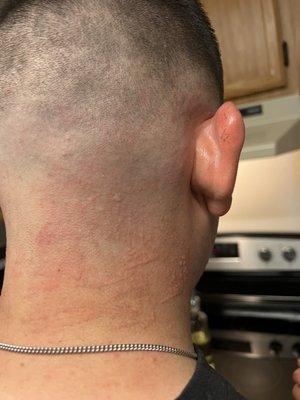 After hair was cut  he had burns and bumps