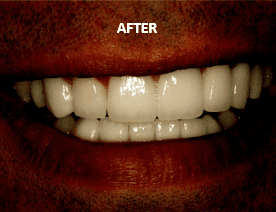 Smile change - AFTER