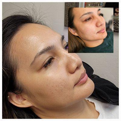 Procell Microchanneling: 2 sessions complete to help with acne scars