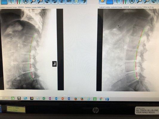 My spinal resultsBefore (Left), after (after). redline gets closer to the green which is what shows the correction.