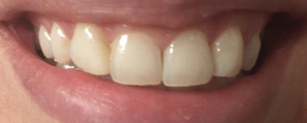 Front teeth before veneers